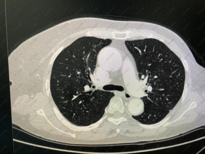 气管异物ct图片