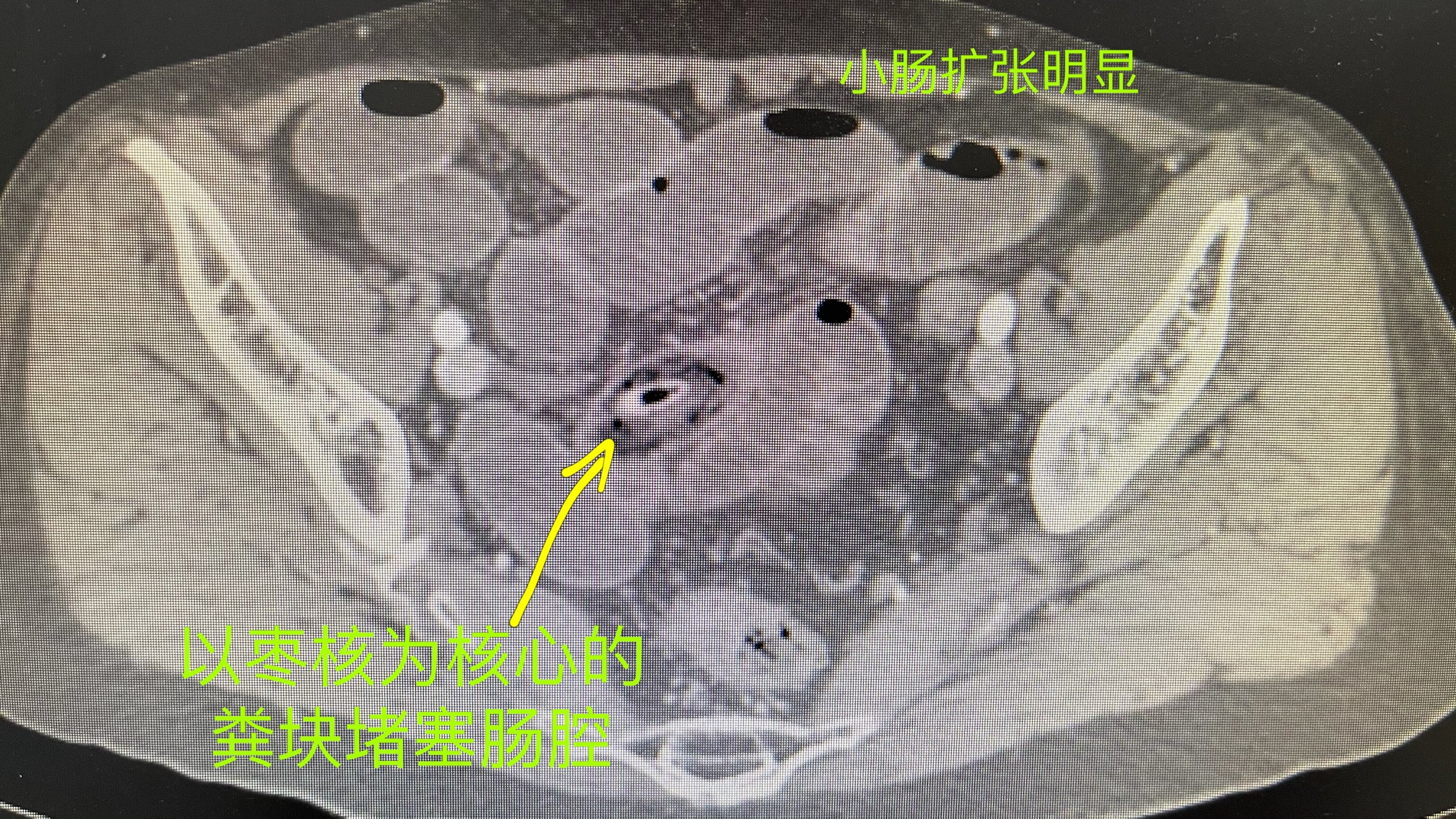 肠穿孔CT图片