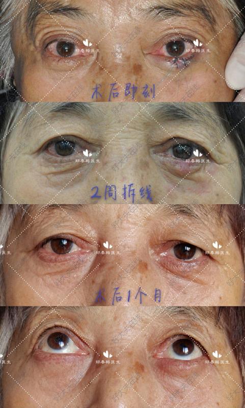 治疗后30天治疗后上,下眼睑的睑缘痣,手术治疗前后对比图,肿物扩大