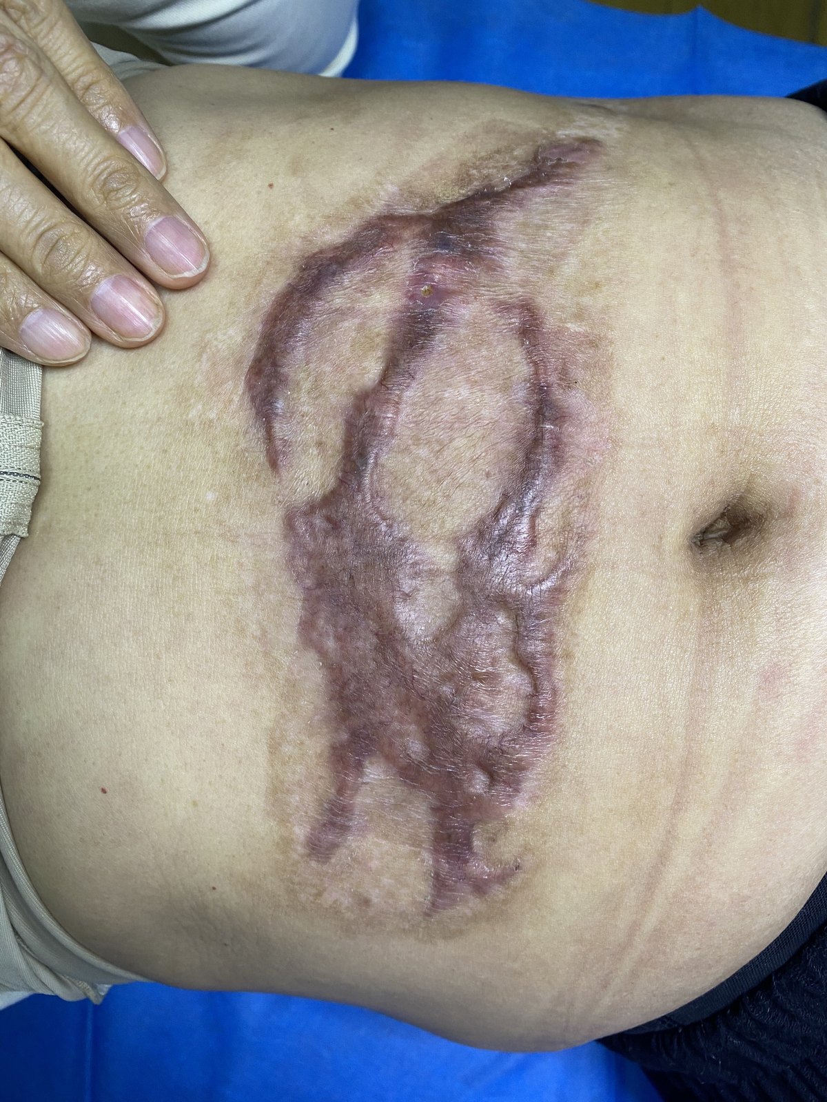 疤痕_疤痕治疗方式