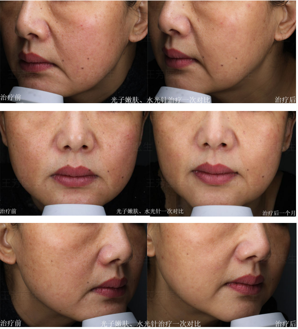光子嫩肤水光针治疗一次对比案例分享_痤疮_治疗方式_治疗介绍 - 好