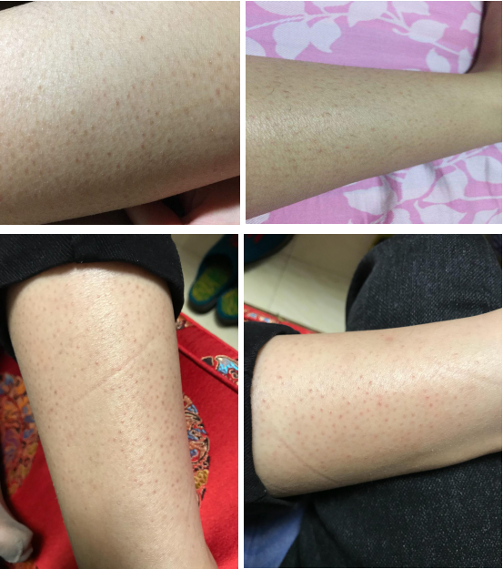 鸡皮肤的汗毛可以消失吗(鸡皮肤的汗毛可以消失吗女生) 鸡皮肤的汗毛可以消失吗(鸡皮肤的汗毛可以消失吗女生)