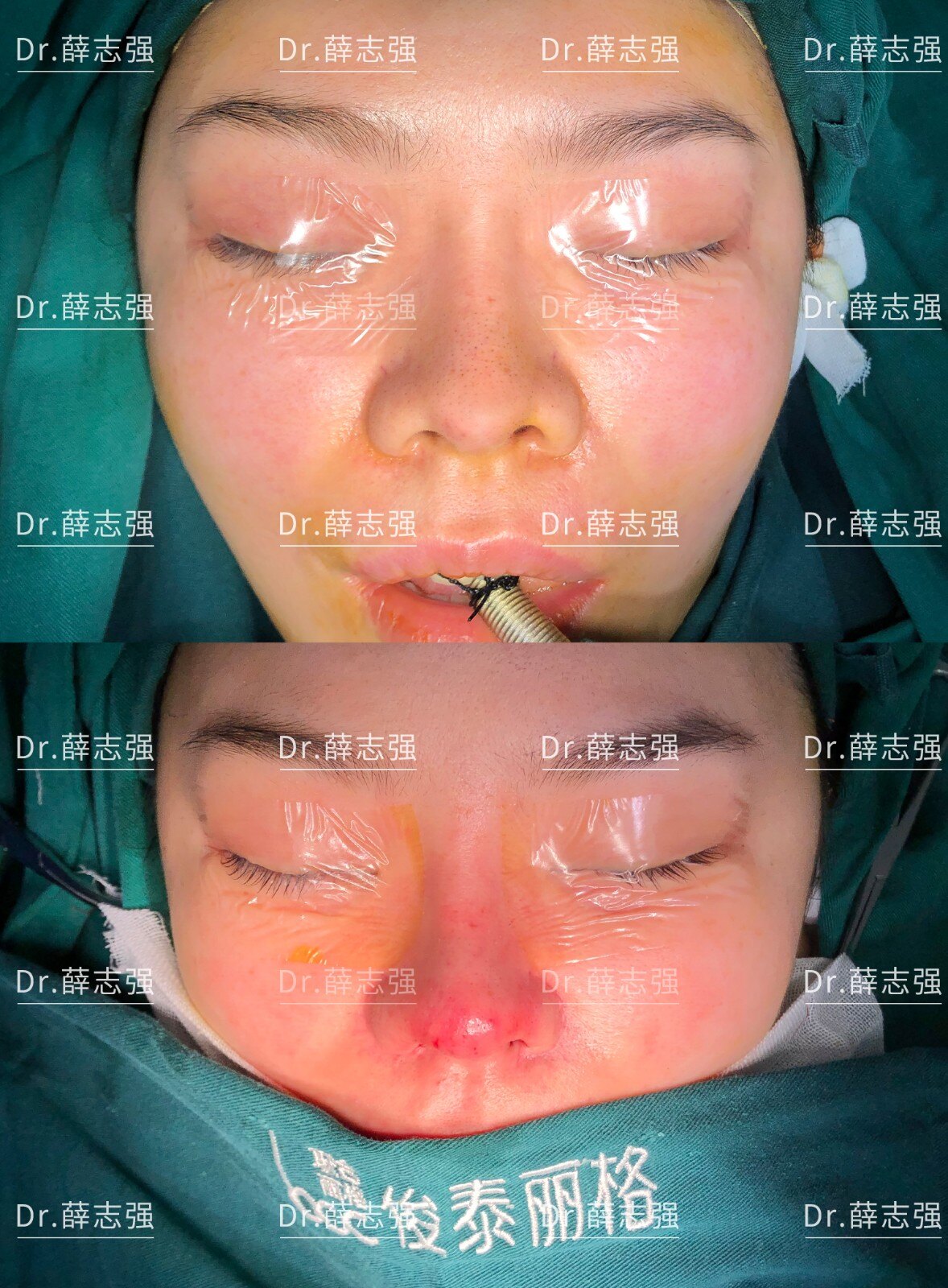 内入路保留鼻修复#【案例分享】_隆鼻 - 好大夫在线