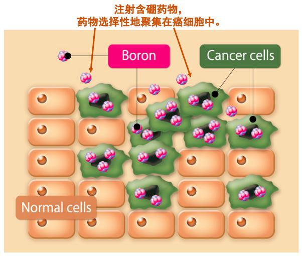 硼中子俘获治疗bnct