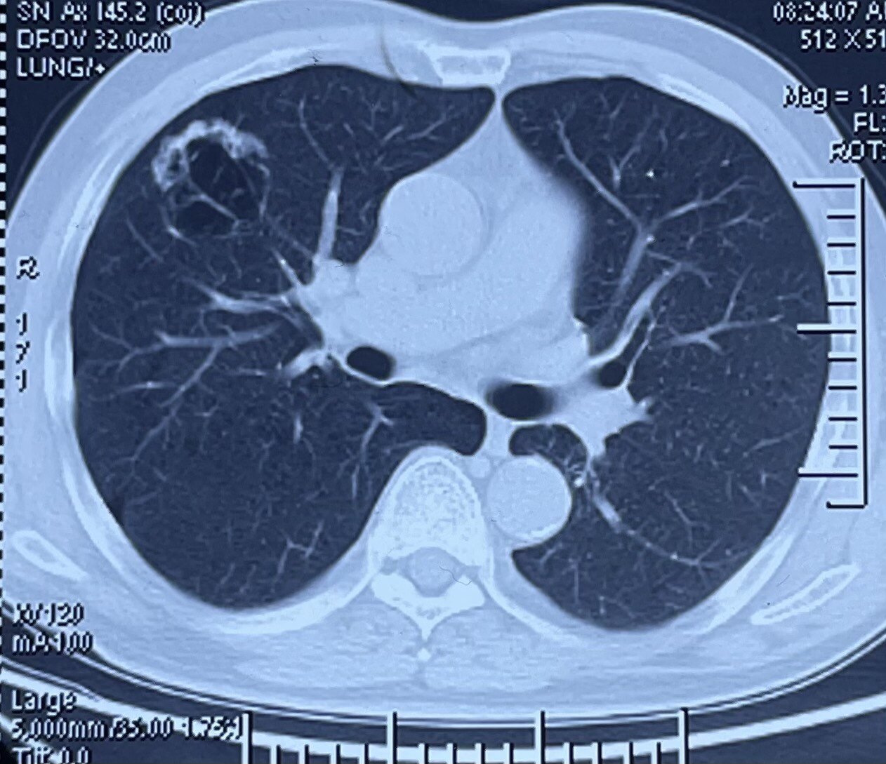 肺大泡ct图片解读图片