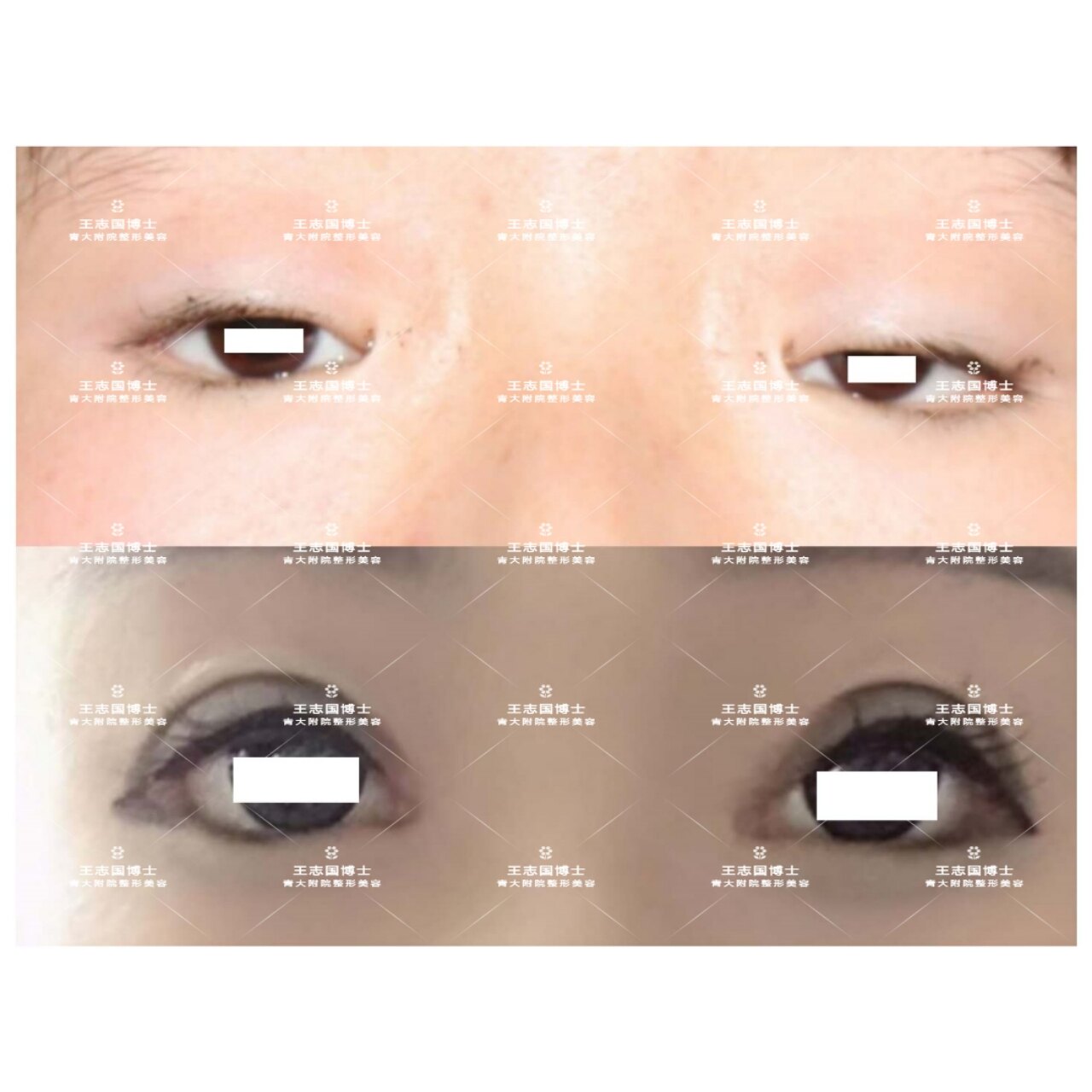 眼睛小不是丑,可能是病_上睑下垂_症状表现_治疗方式 好大夫在线