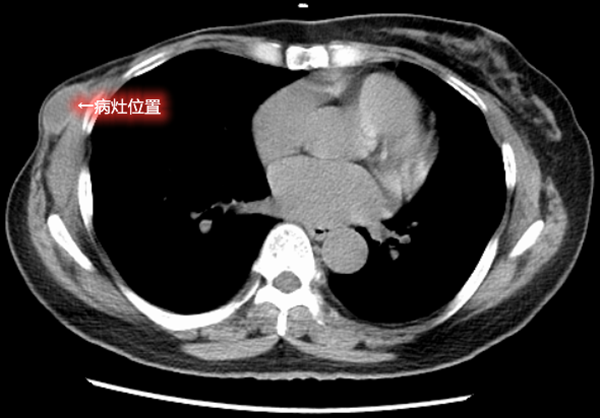 乳腺癌术后的胸壁结节都是恶性的吗