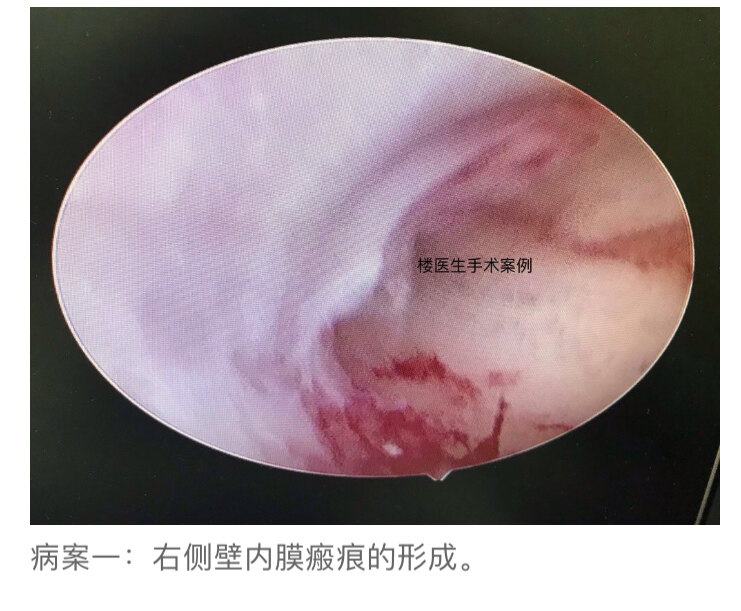 内膜瘢痕化图片的样子图片