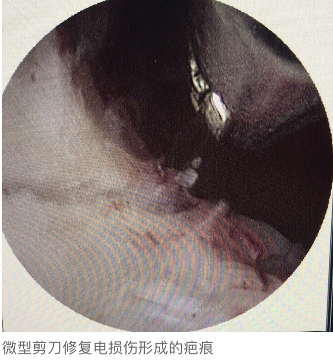 内膜瘢痕化图片的样子图片