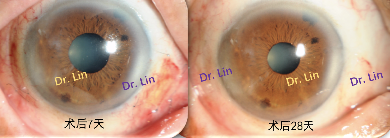 缝线在位,创口愈合好,予以拆线;右图:术后28天照片,结膜无充血,角膜