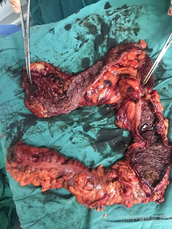 直肠结肠双原发癌手术_直肠癌 - 好大夫在线