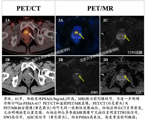 psma pet-ct/mri检测,让前列腺癌微小病灶无处遁形!