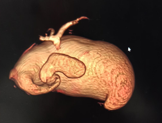 胆总管囊肿_先天性胆管扩张症_介绍_治疗方式 - 好大夫在线