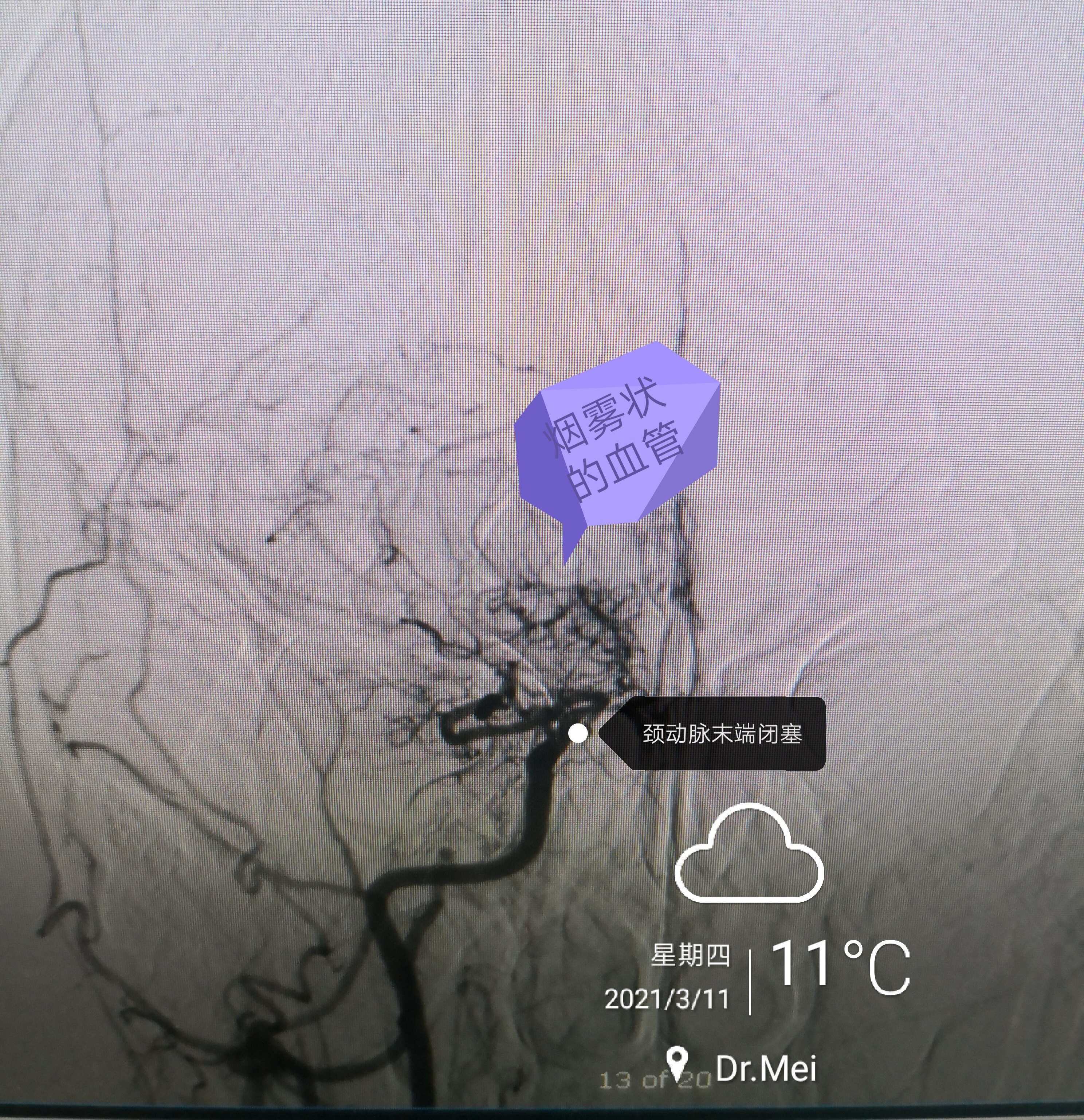 中青年人性格发生改变要当心烟雾病_烟雾病_介绍_症状表现- 好大夫在线