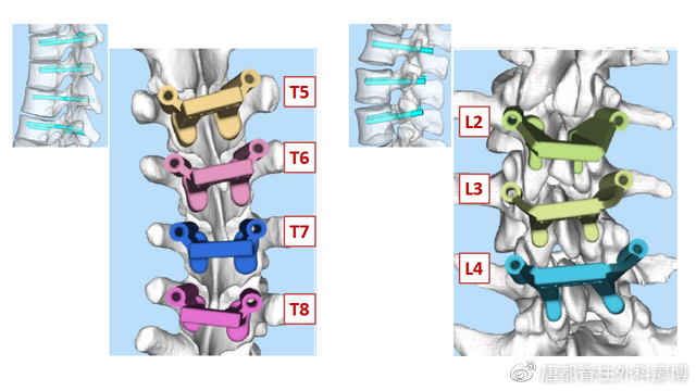 无椎体发育畸形神经系统畸形筛检(-)器官畸形筛检(-)l5 tilt: 8° (21