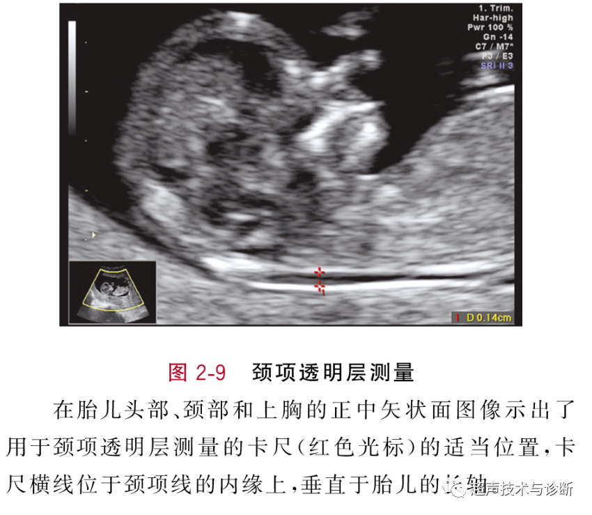 双顶径测量标准切面图片