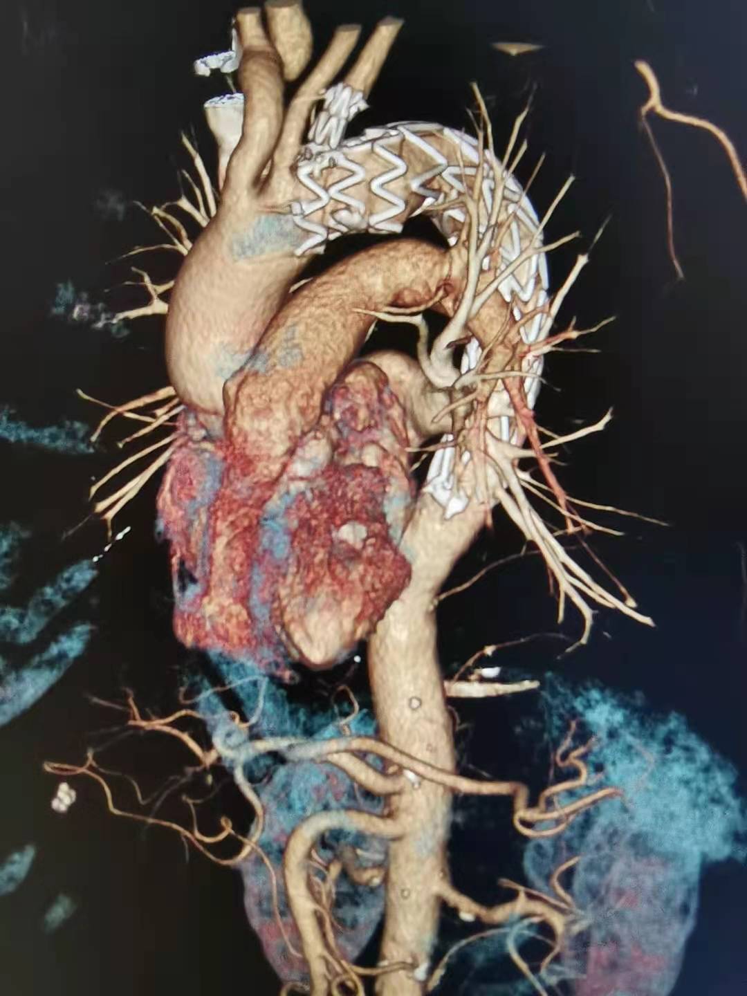 主动脉窦瘤图片图片