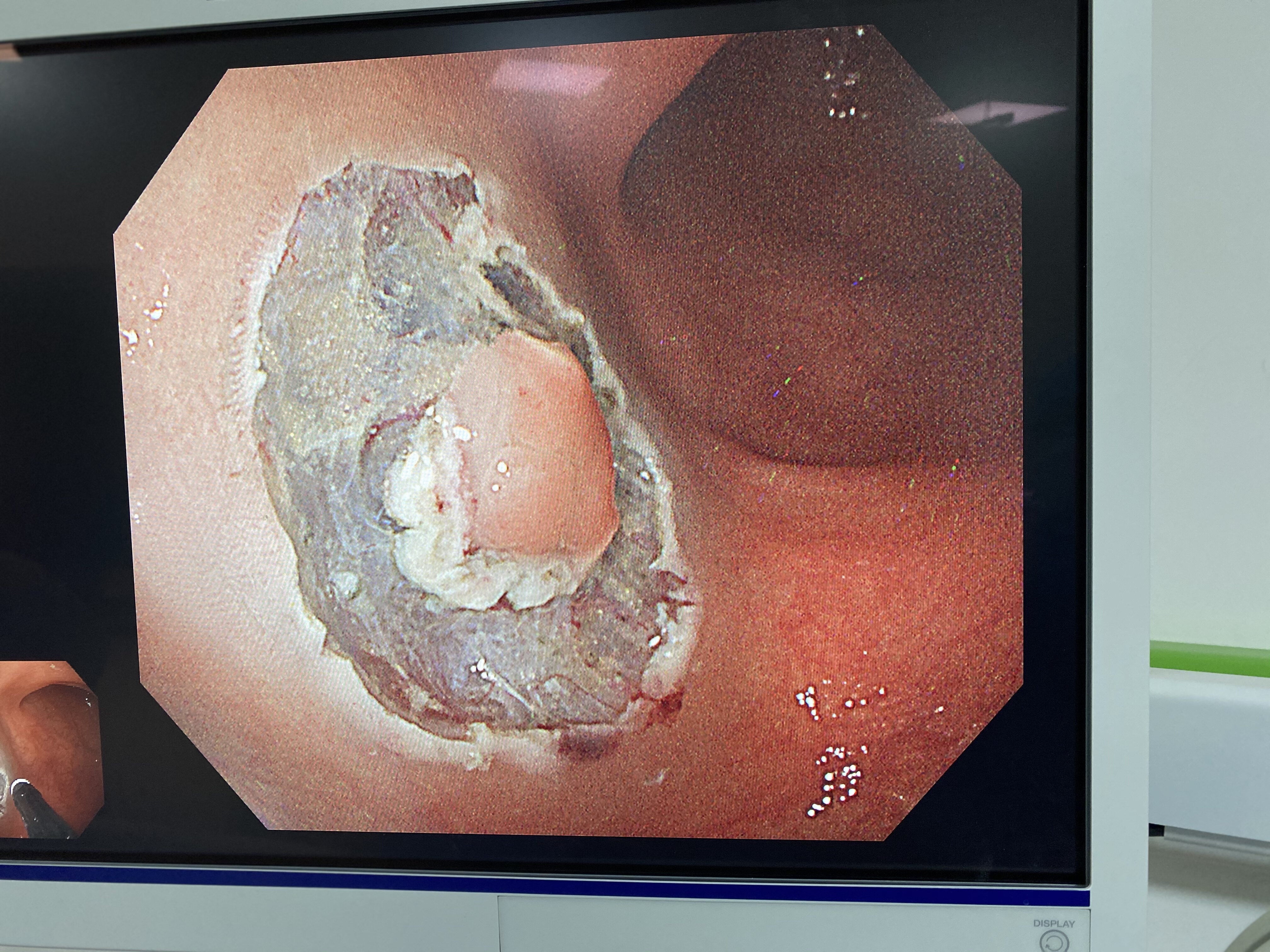 西安市胸科医院消化中心今日成功完成第一例结肠lstesd治疗 - 好大夫