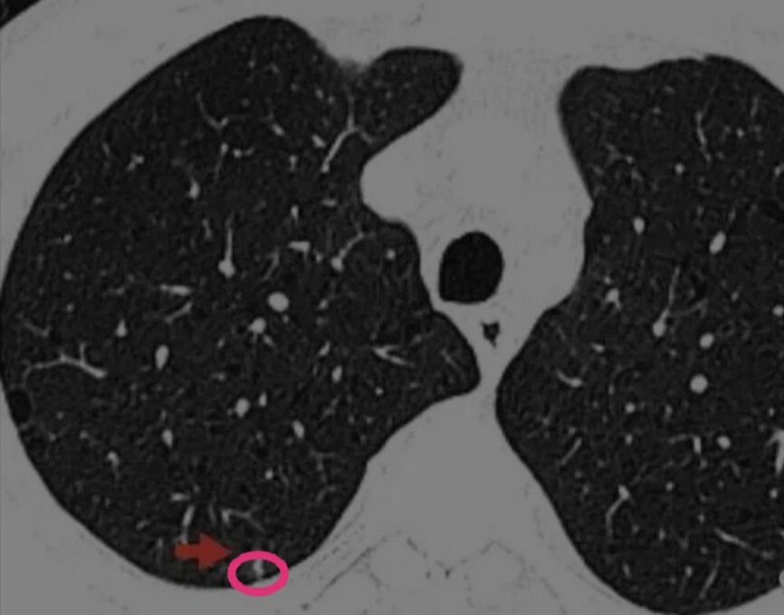 肺部实性结节图片