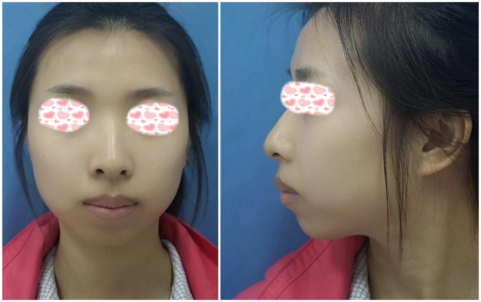 还有很多其他有缺陷的面型,长脸,突嘴,面部偏斜,地包天,天包地等等,也