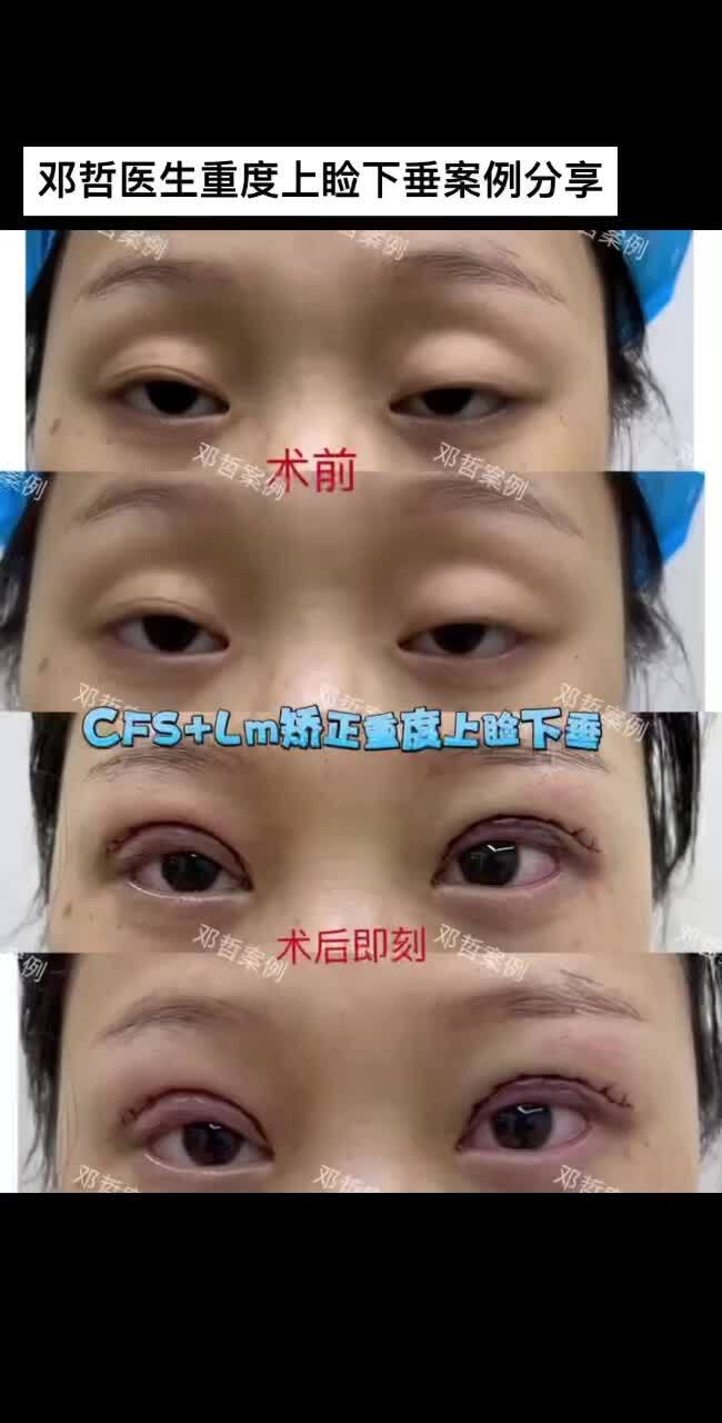 視頻封面