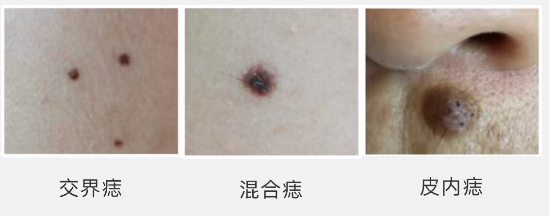 身上突然长痦子,是有什么预兆吗_痣_介绍_治疗方式 - 好大夫在线