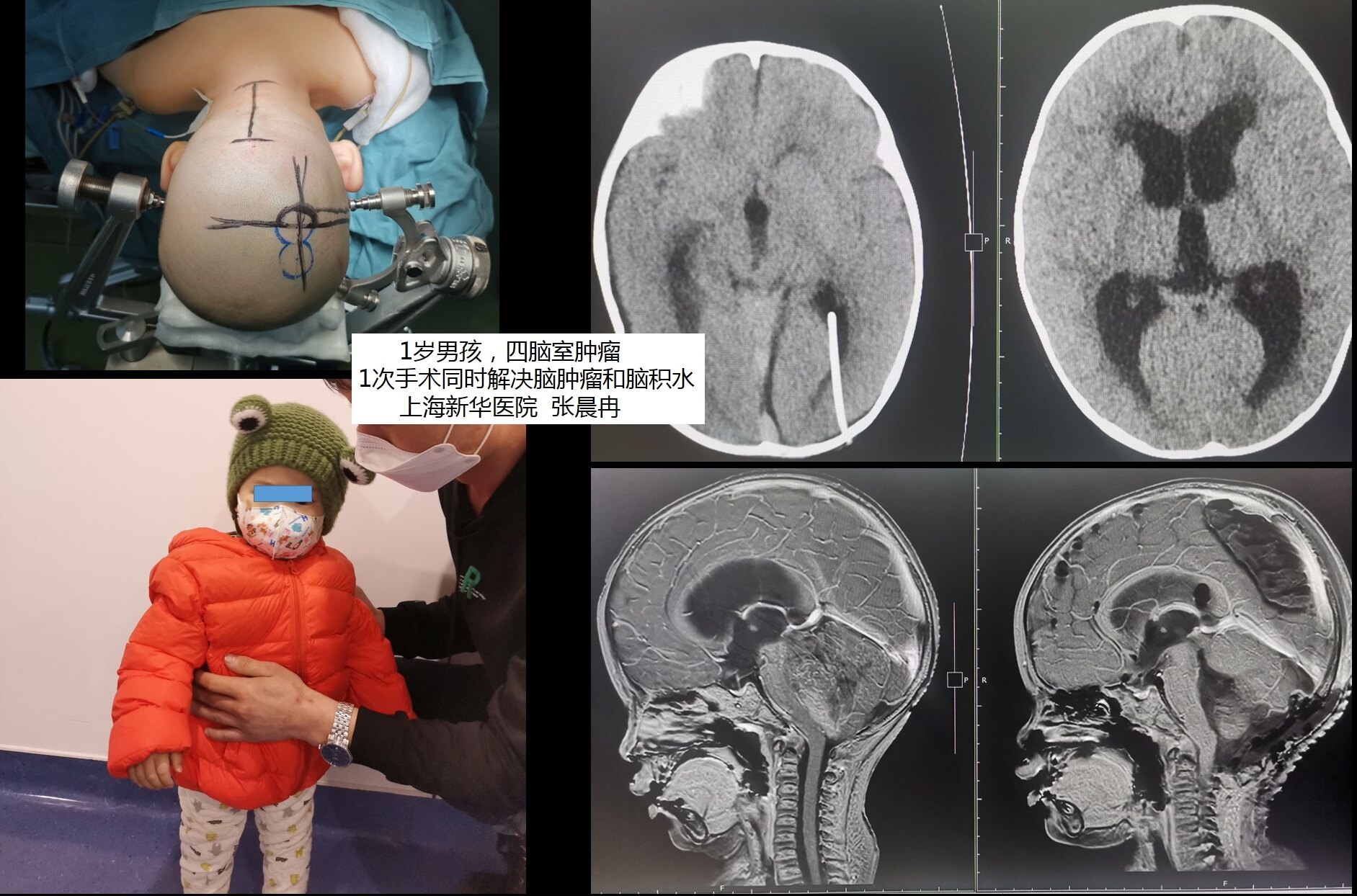 四腦室腫瘤伴多層菊形團的胚胎性腫瘤etmr