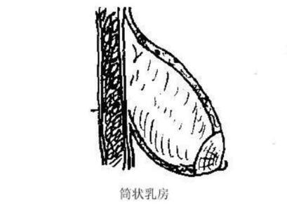 管状乳房