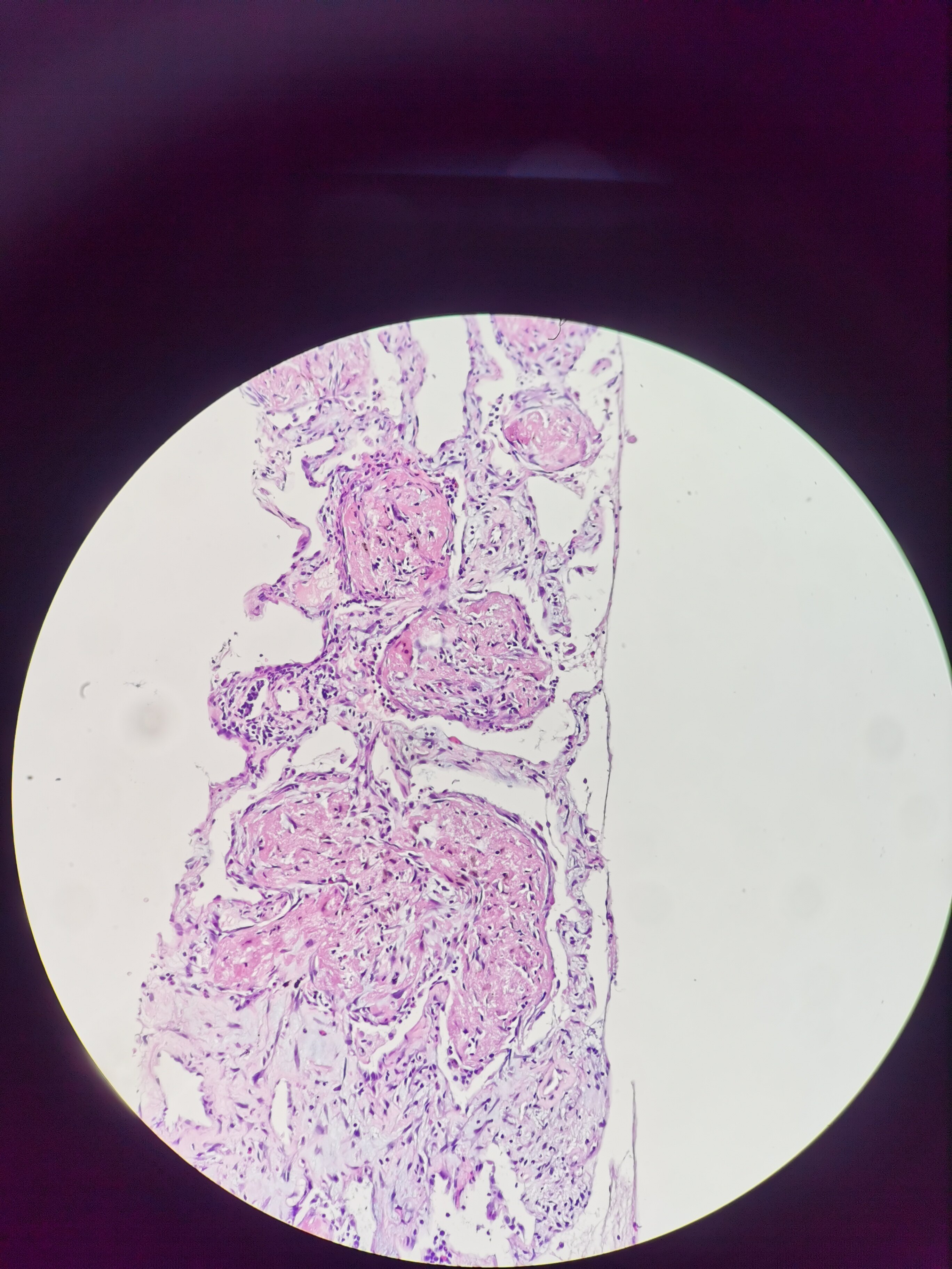 肺典型机化性肺炎组织学改变 - 好大夫在线
