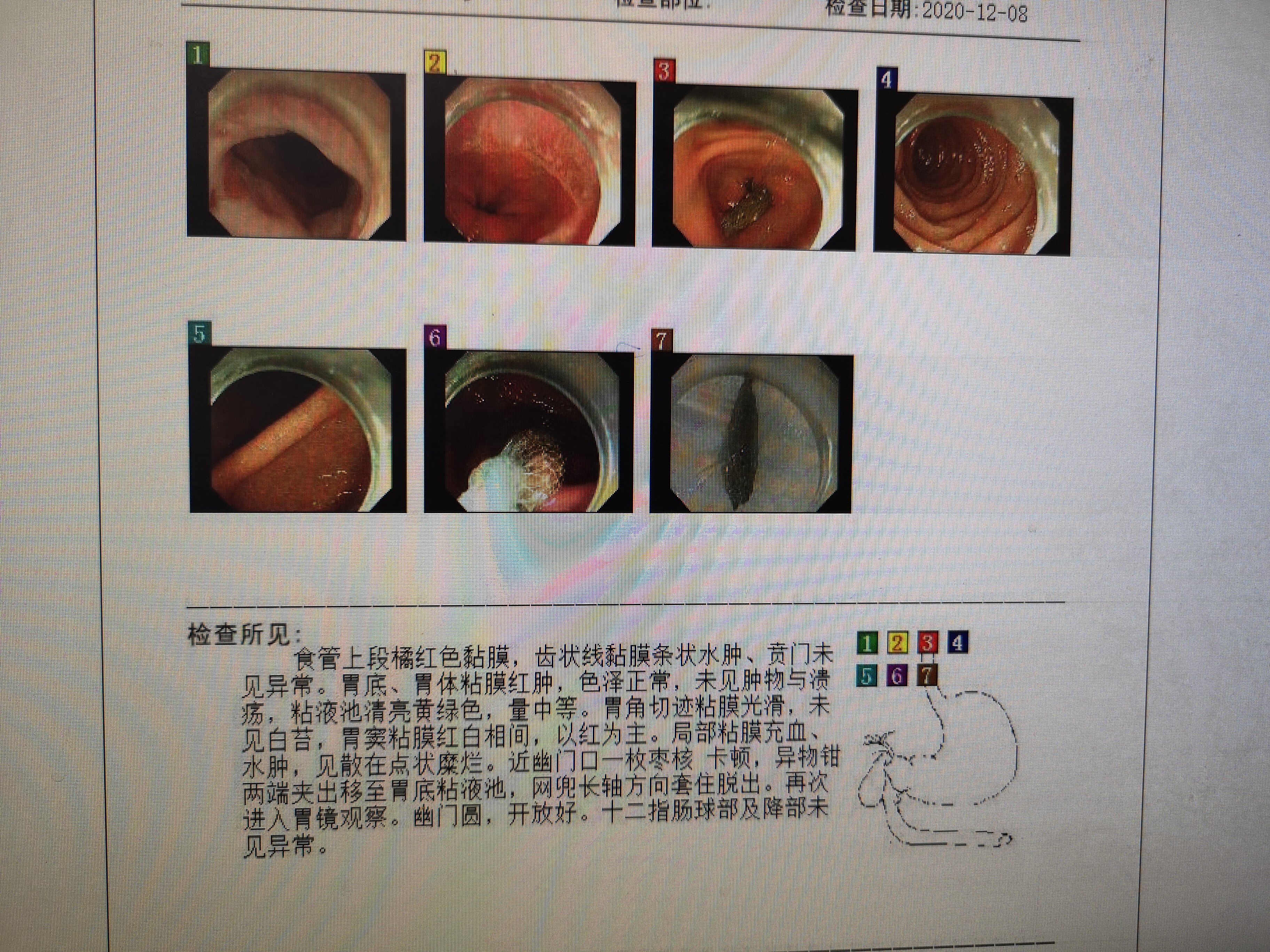 因為吃棗核,導致胃腸道穿孔的患者太多了,每年有好幾個.