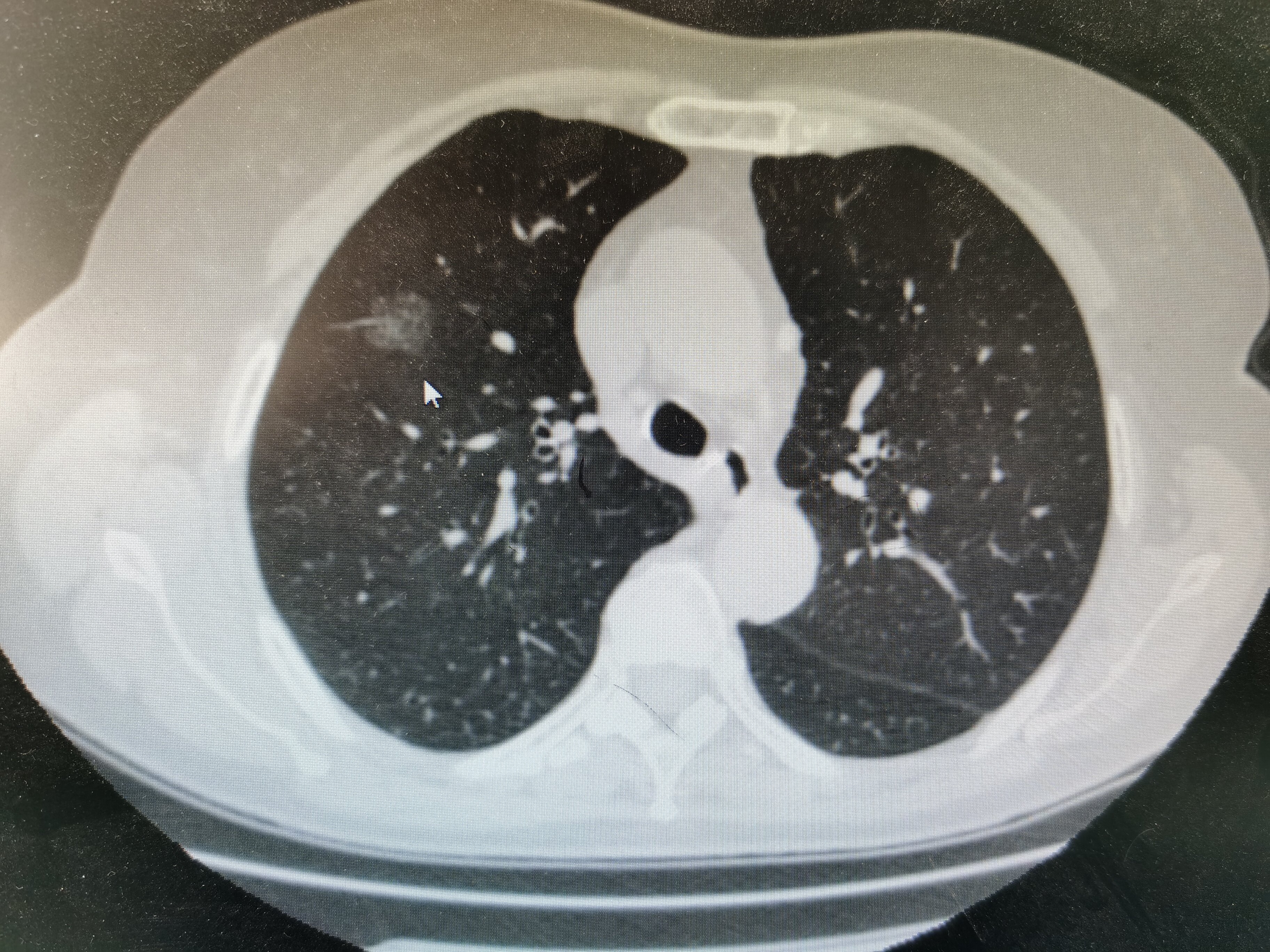 肺部结节 肺部结节