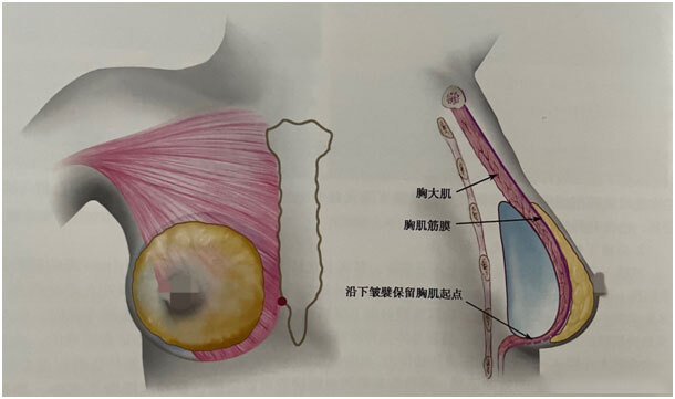 胸大肌下.jpg