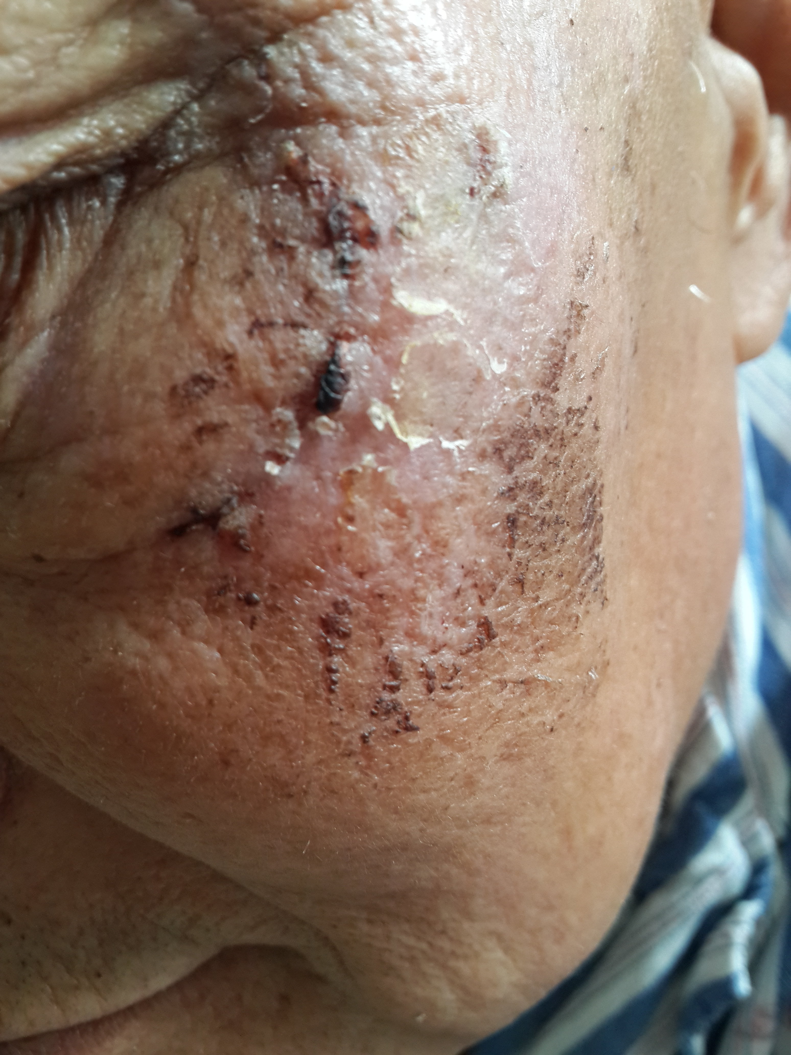 面部外伤拆线后 - 好大夫在线