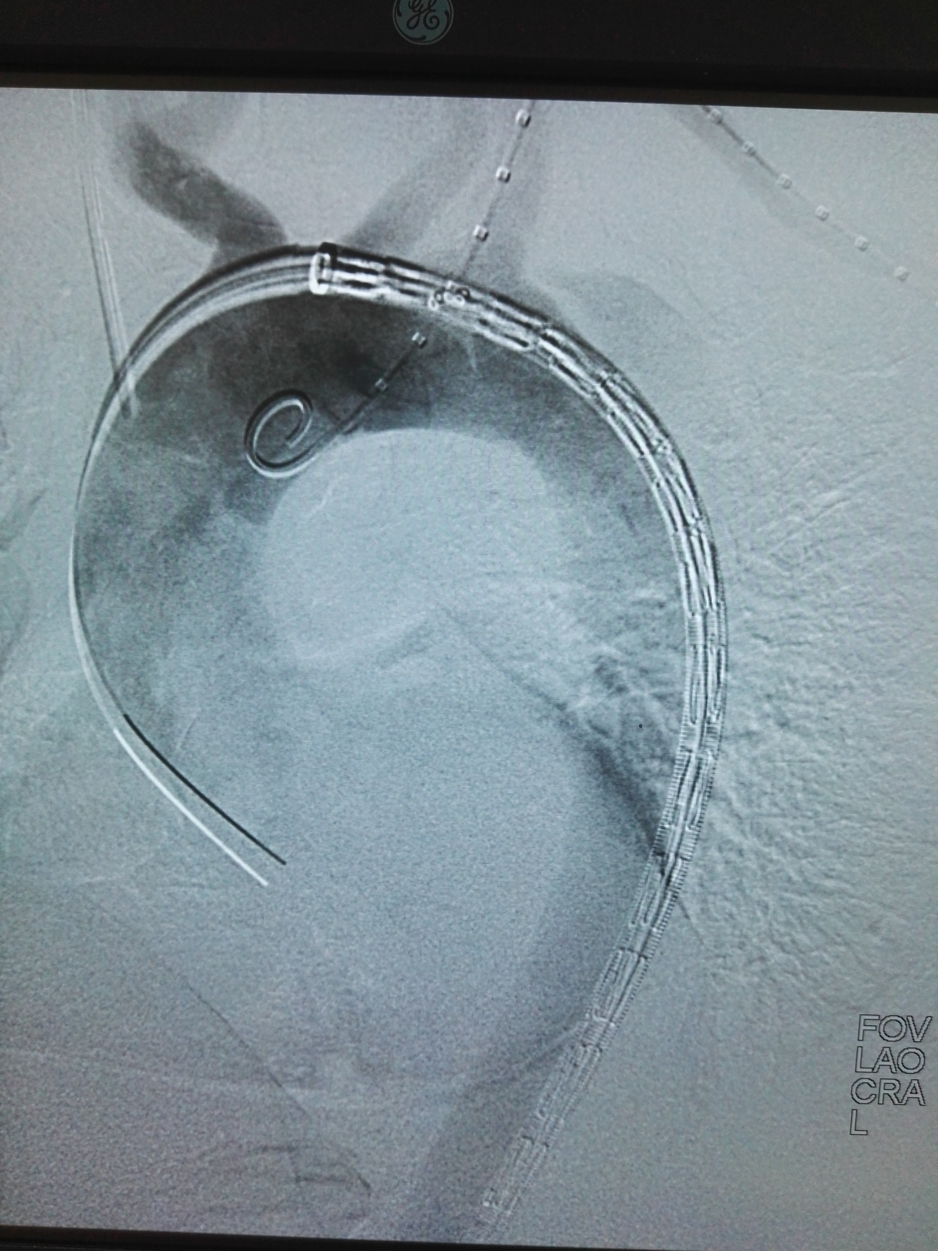 动脉夹层破裂能自愈吗_冠状动脉夹层破裂什么人容易得_破裂动脉夹层容易得冠状人员吗