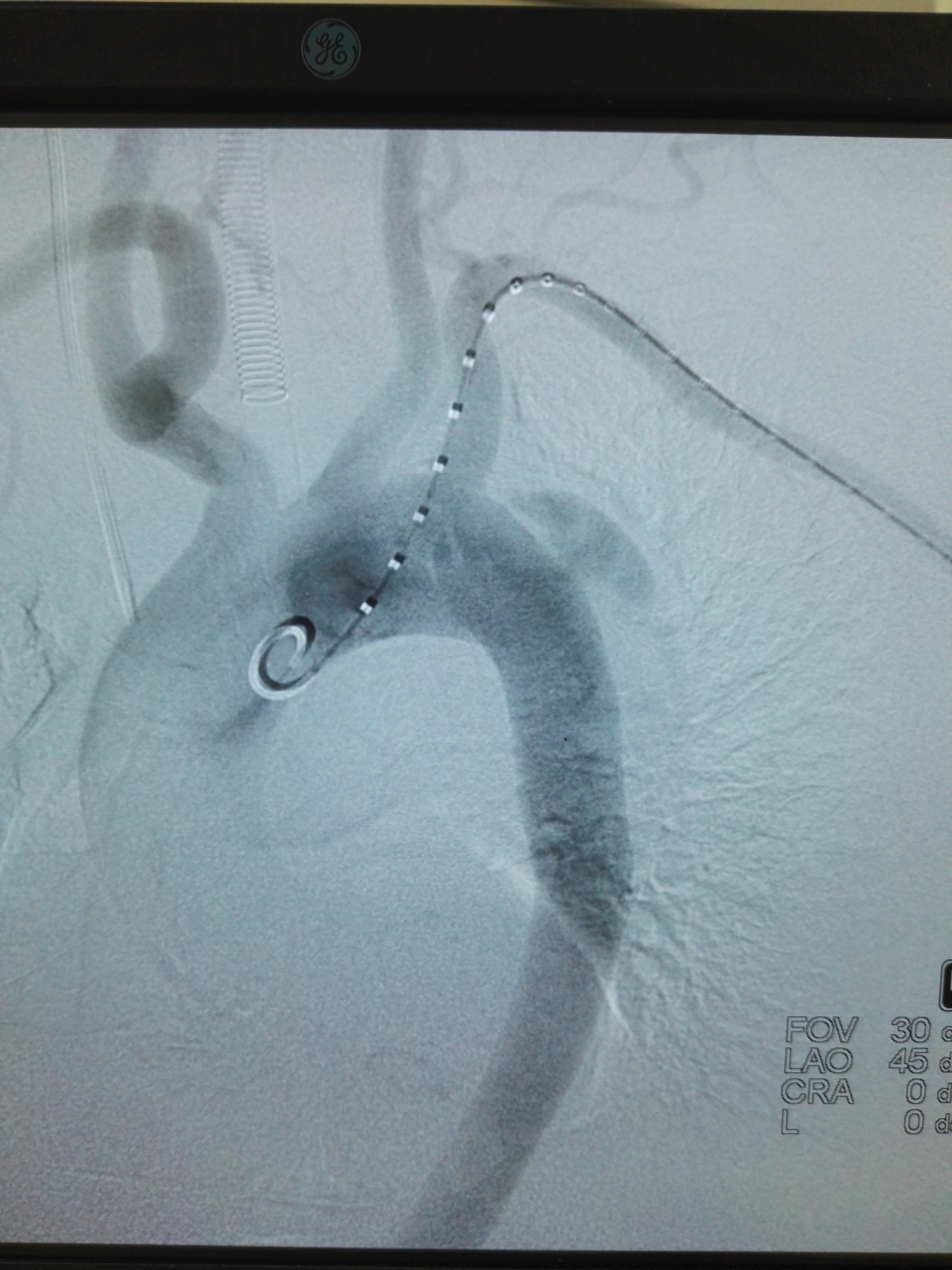 b型主动脉夹层动脉瘤 - 好大夫在线