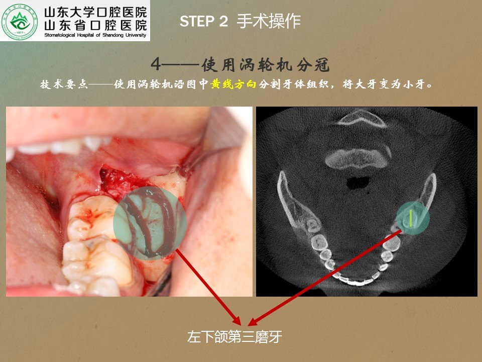 疑難複雜牙拔除系列1——第二磨牙根方的骨埋伏阻生牙