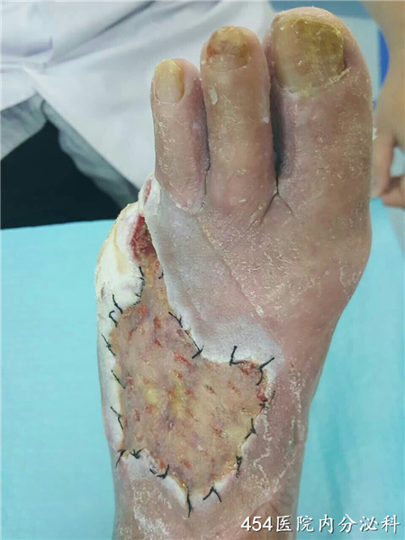 5,左足背植皮术后愈合良好