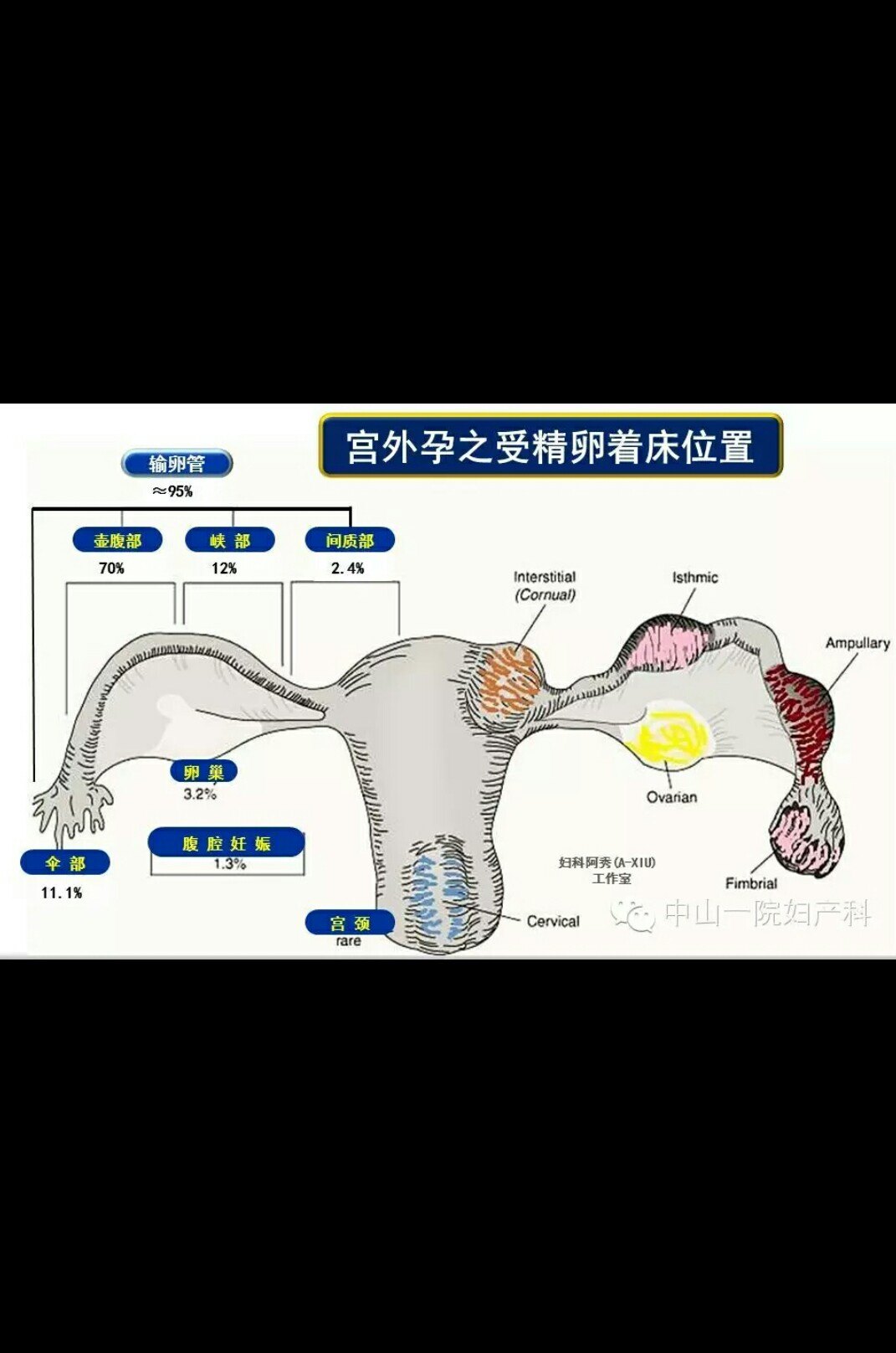 宫外孕图片 示意图图片