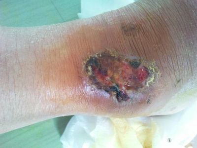 4,环境分枝杆菌皮肤感染:在环境中存在一群类似结核一样的分枝杆菌