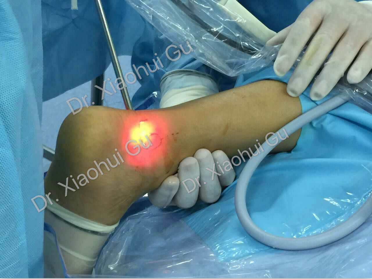 全踝关节镜下微创修复技术使您重返运动场成为可能