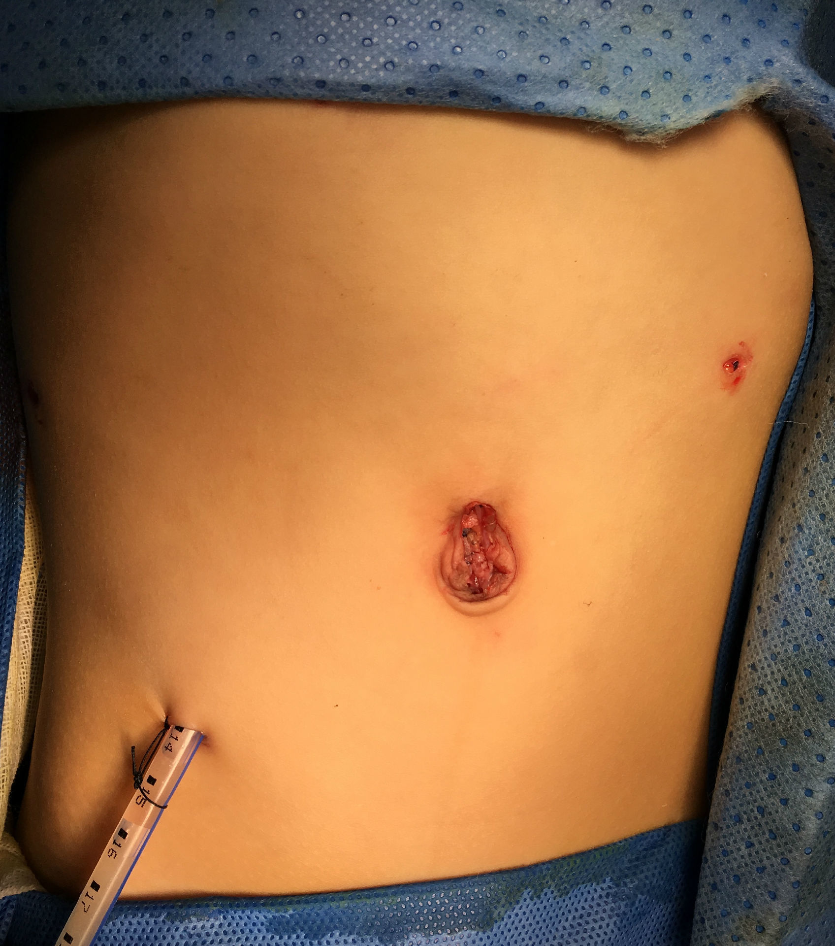 胆结石治疗费用_胆结石治疗贵吗_治疗胆结石花多少钱