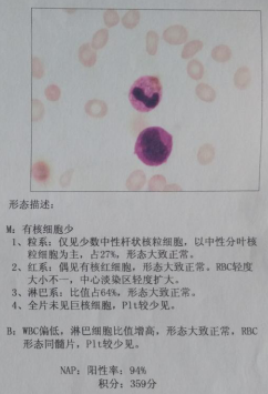 行骨髓穿刺,骨髓活检,染色体分析等检查,确诊为慢性再生障碍性贫血