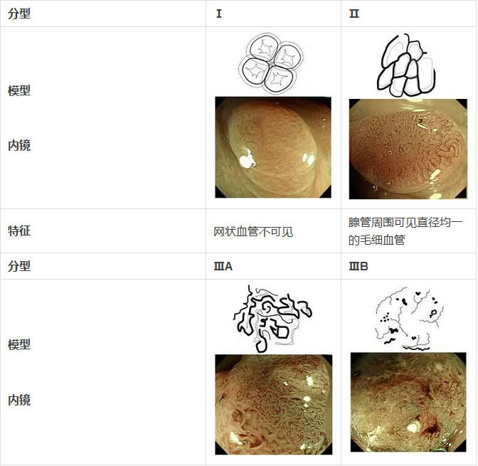 图文详解:结肠息肉切除术