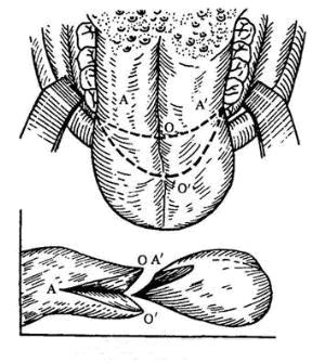 先天性巨舌症的治疗