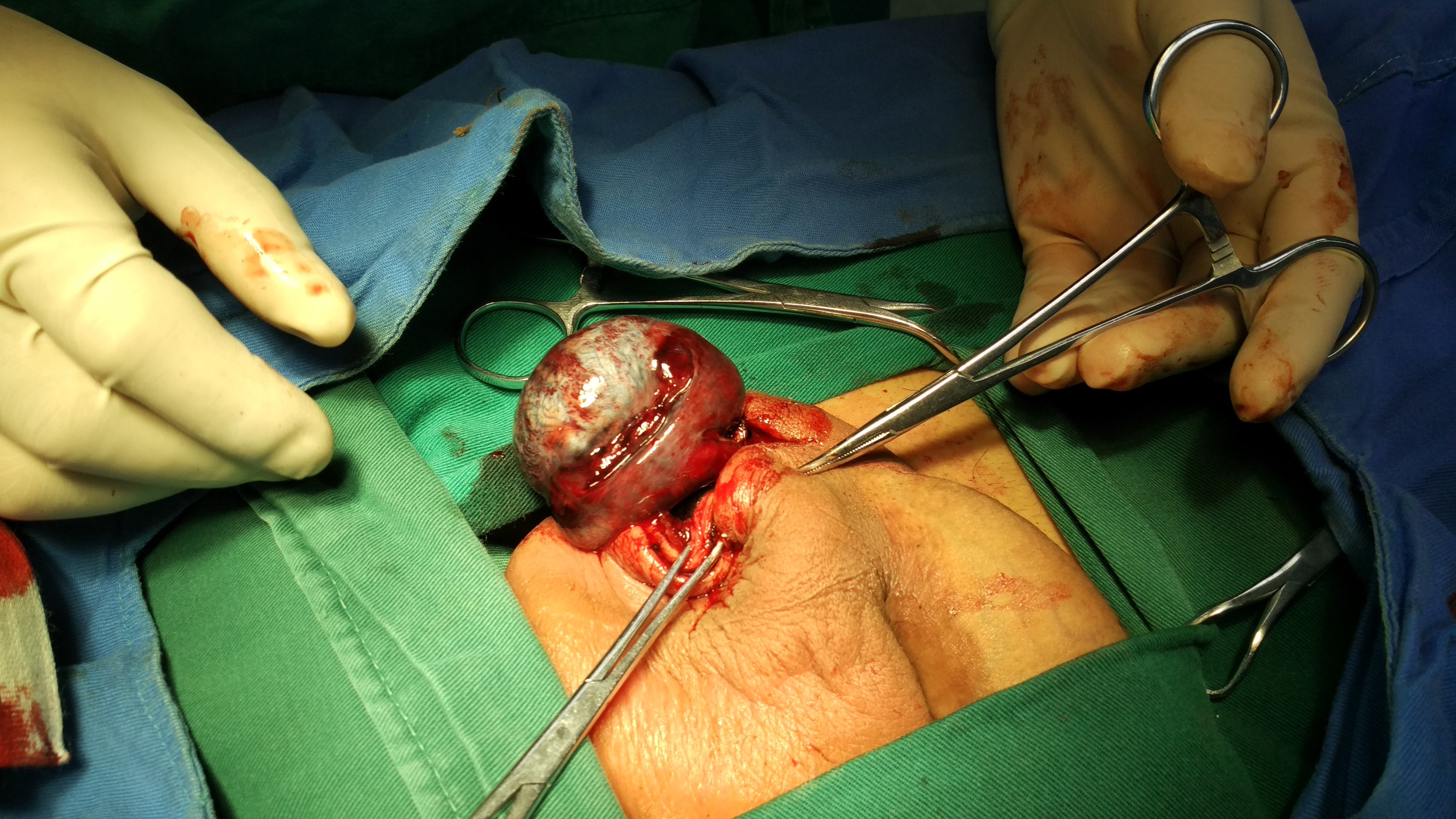 睾丸囊肿切除手术图片图片