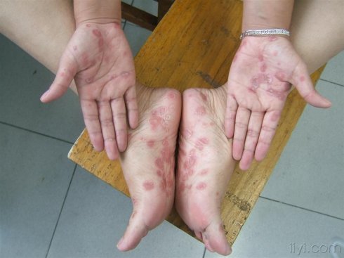 二期梅毒手足心领圈样皮疹,与玫瑰糠疹非常像,但是不是玫瑰糠疹好发