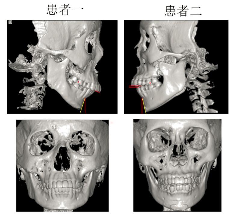 下巴沒了,門牙沒法咬這是怎麼了?(骨關節病 程度分級)