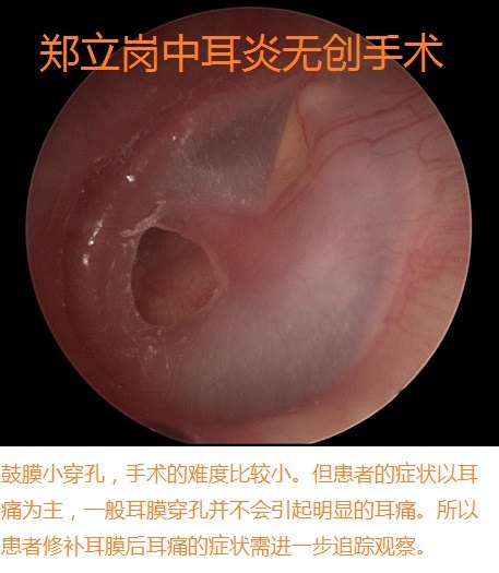 前言:中耳炎微創手術是目前治療慢性化膿性中耳炎及膽脂瘤型中耳炎最