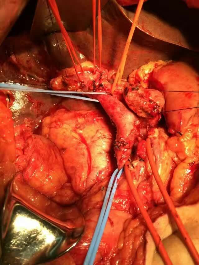 十二指肠壶腹部肿瘤图片