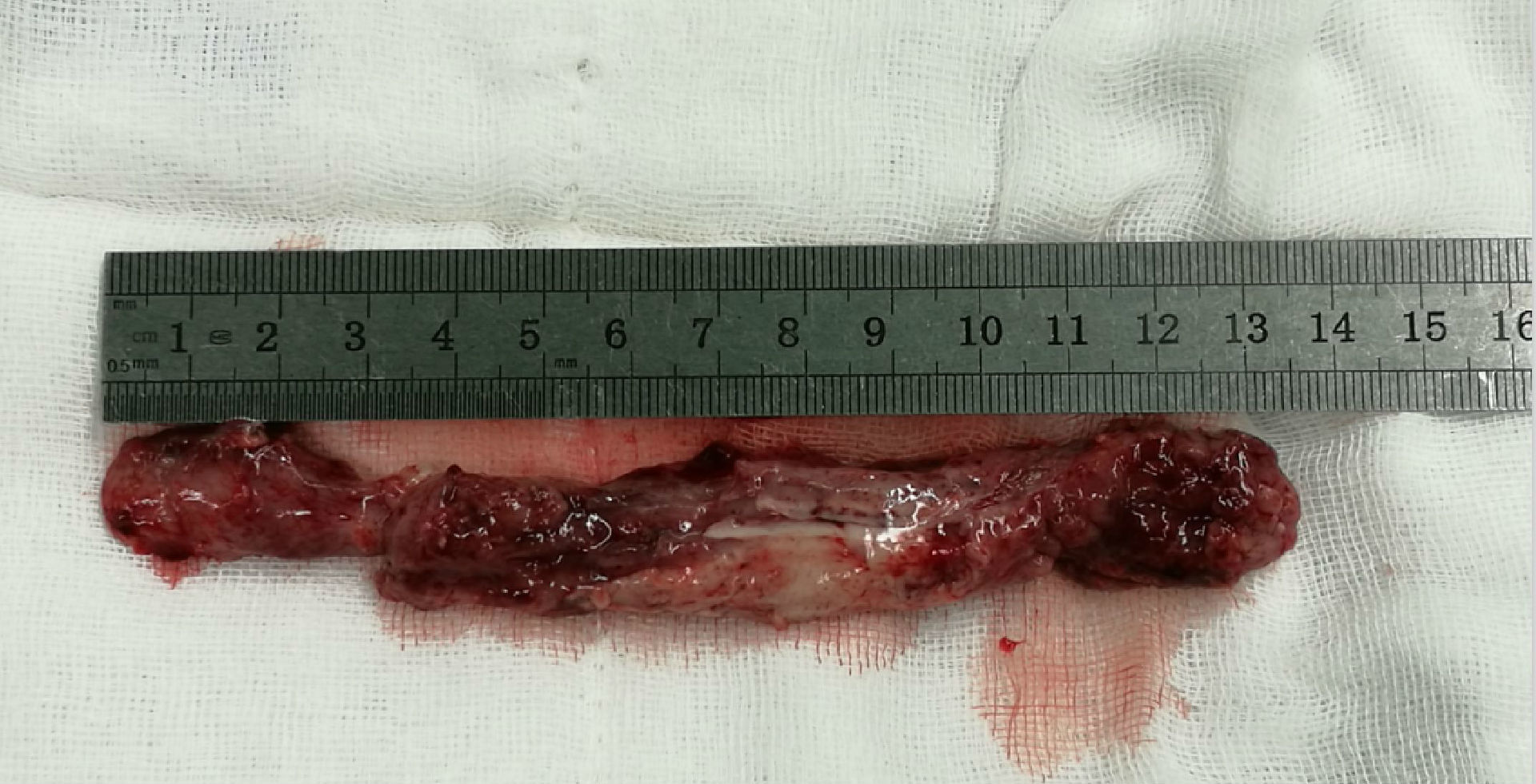 t1-t7长节段脊髓胶质瘤切除 内固定术 - 好大夫在线